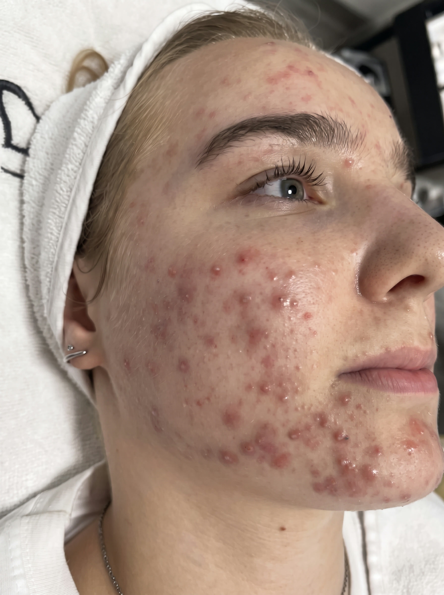 Fine vor der Aknebehandlung bei Beauty Concept Munich