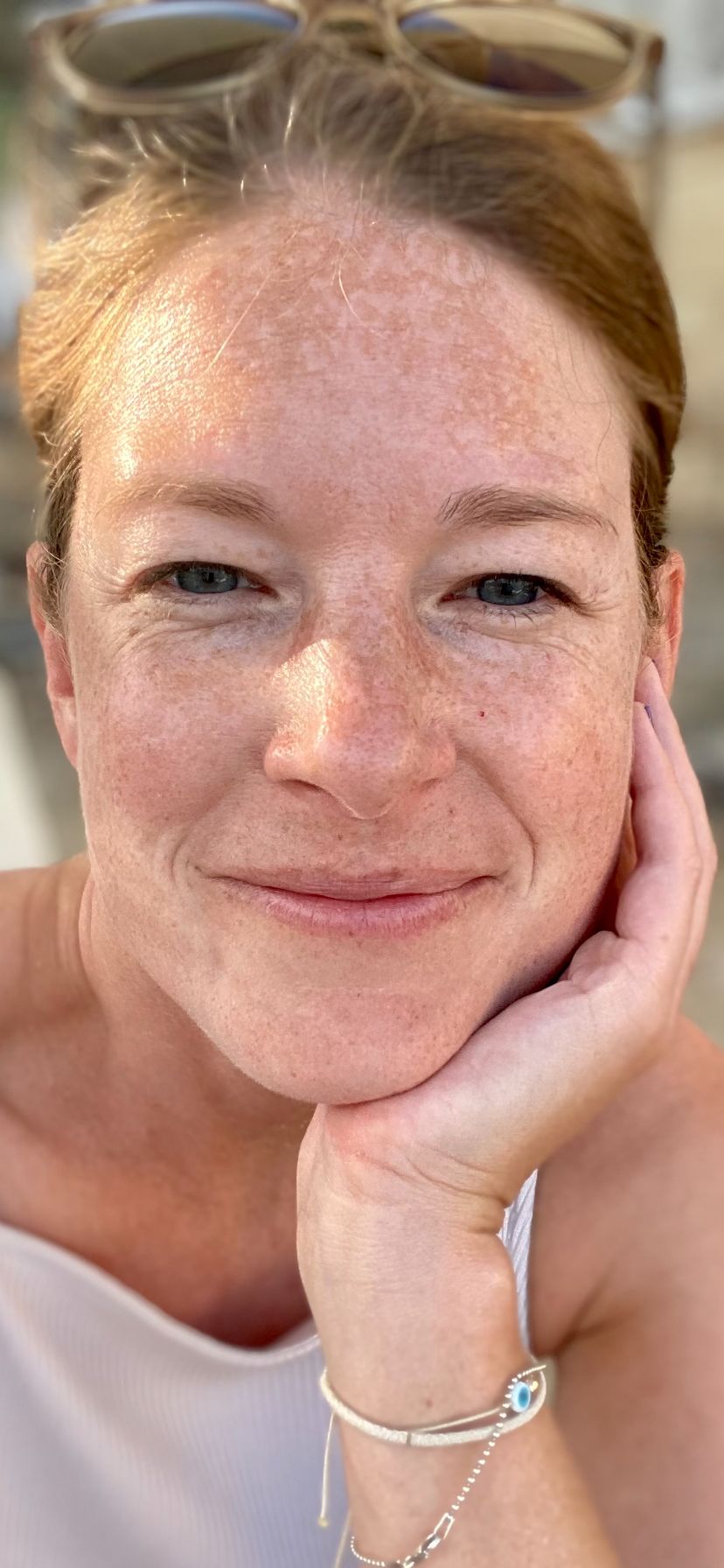 Luisa vor der Behandlung von Hyperpigmentierung bei Beauty Concept Munich