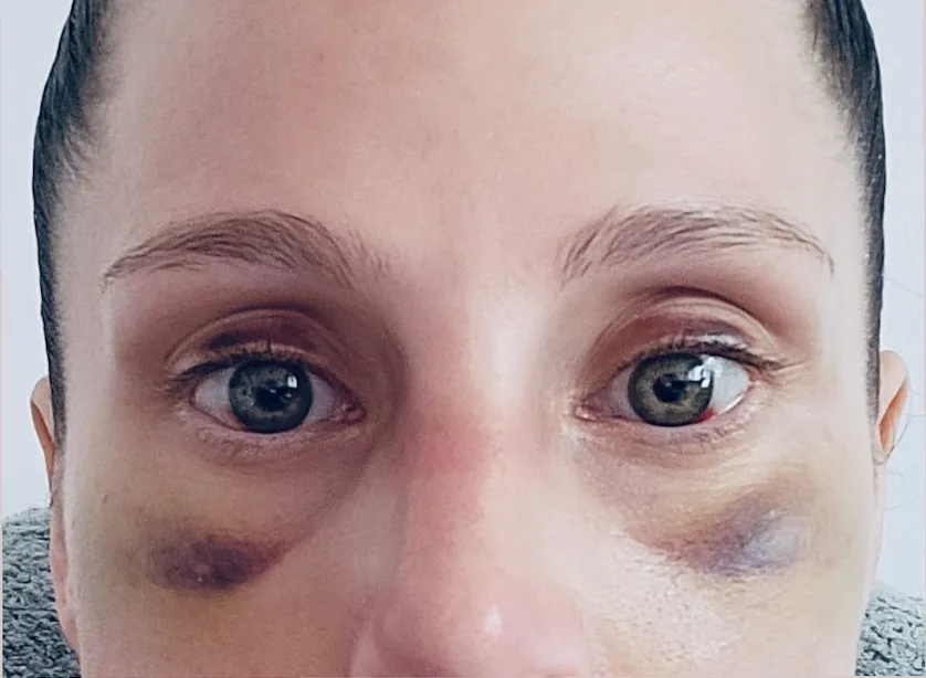 Augenpartie vor der manuellen Lymphdrainage nach einer Operation bei Beauty Concept Munich